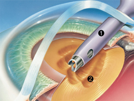 백내장제거 과정2