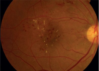 당뇨황반부종사진1