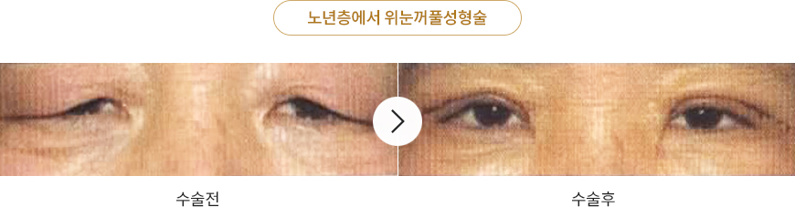 노년층에서 위눈꺼풀성형술